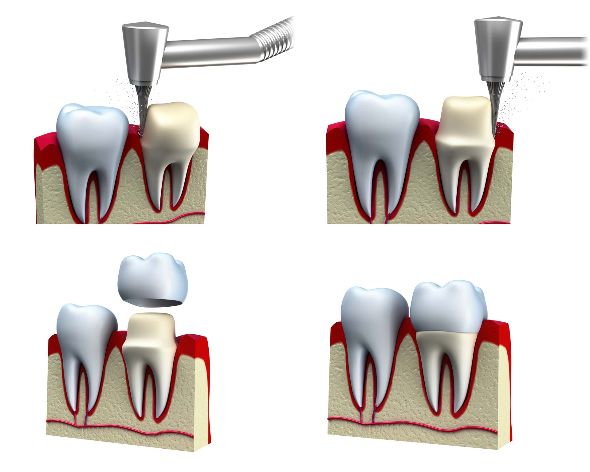 Dental Crowns – Needs and Material Used | Monash Dental Group