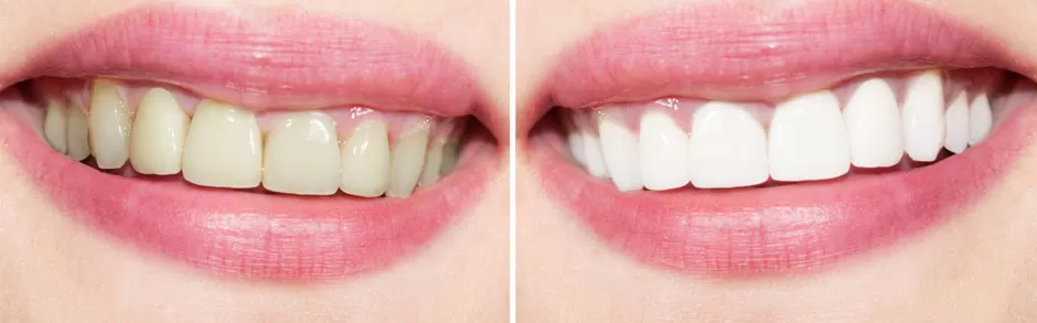 Teeth Whitening â€