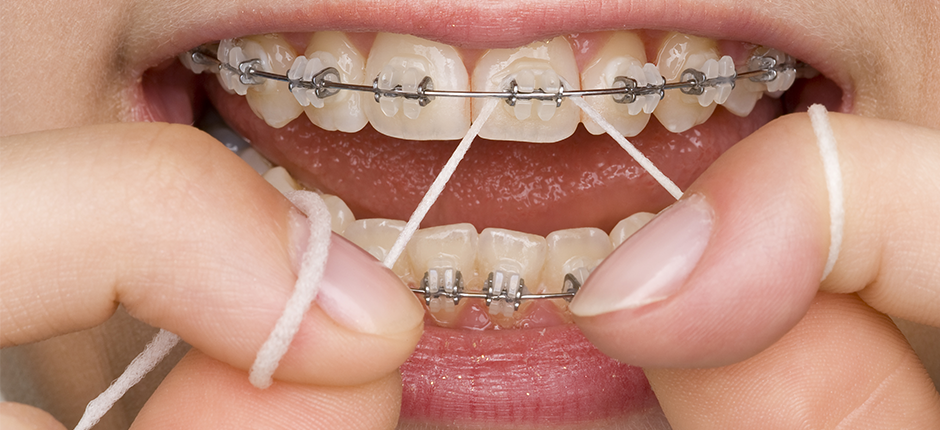 perawatan gigi behel