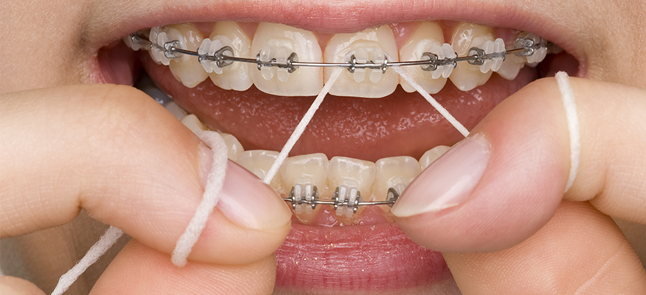 Dental Care with Braces