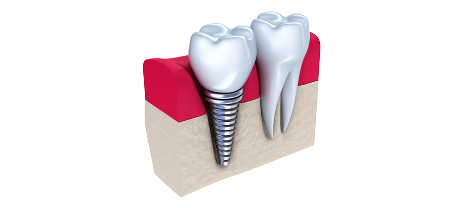 Dental Implant